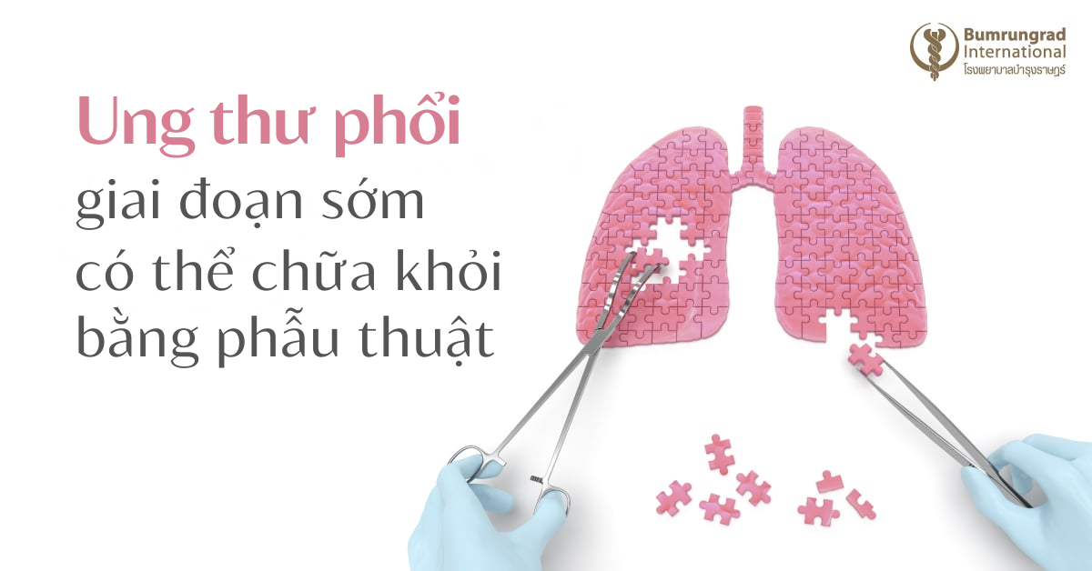 Ung thư phổi giai đoạn sớm có thể chữa khỏi bằng phẫu thuật