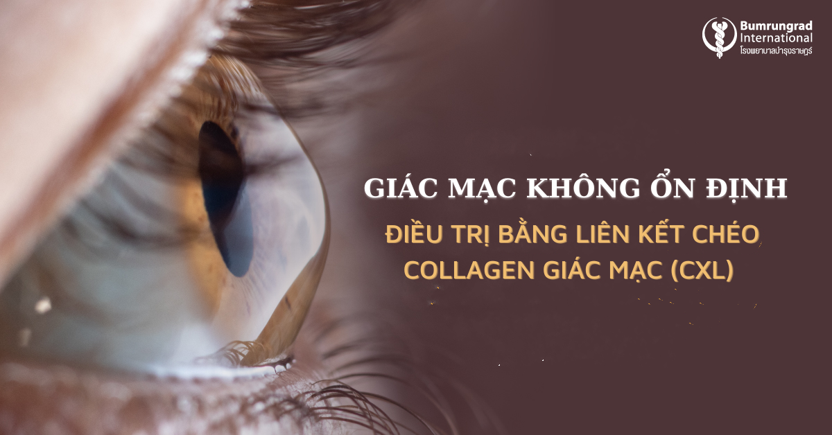 Giác mạc không ổn định điều trị bằng liên kết chéo collagen giác mạc CXL