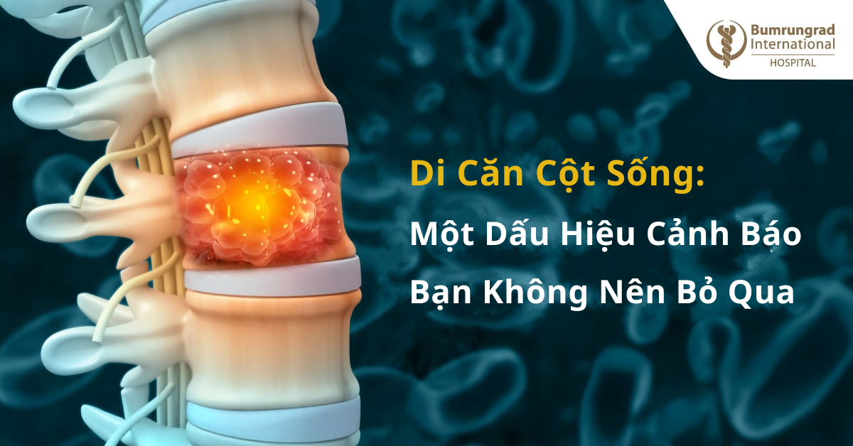 Di Căn Cột Sống: Một Dấu Hiệu Cảnh Báo Bạn Không Nên Bỏ Qua