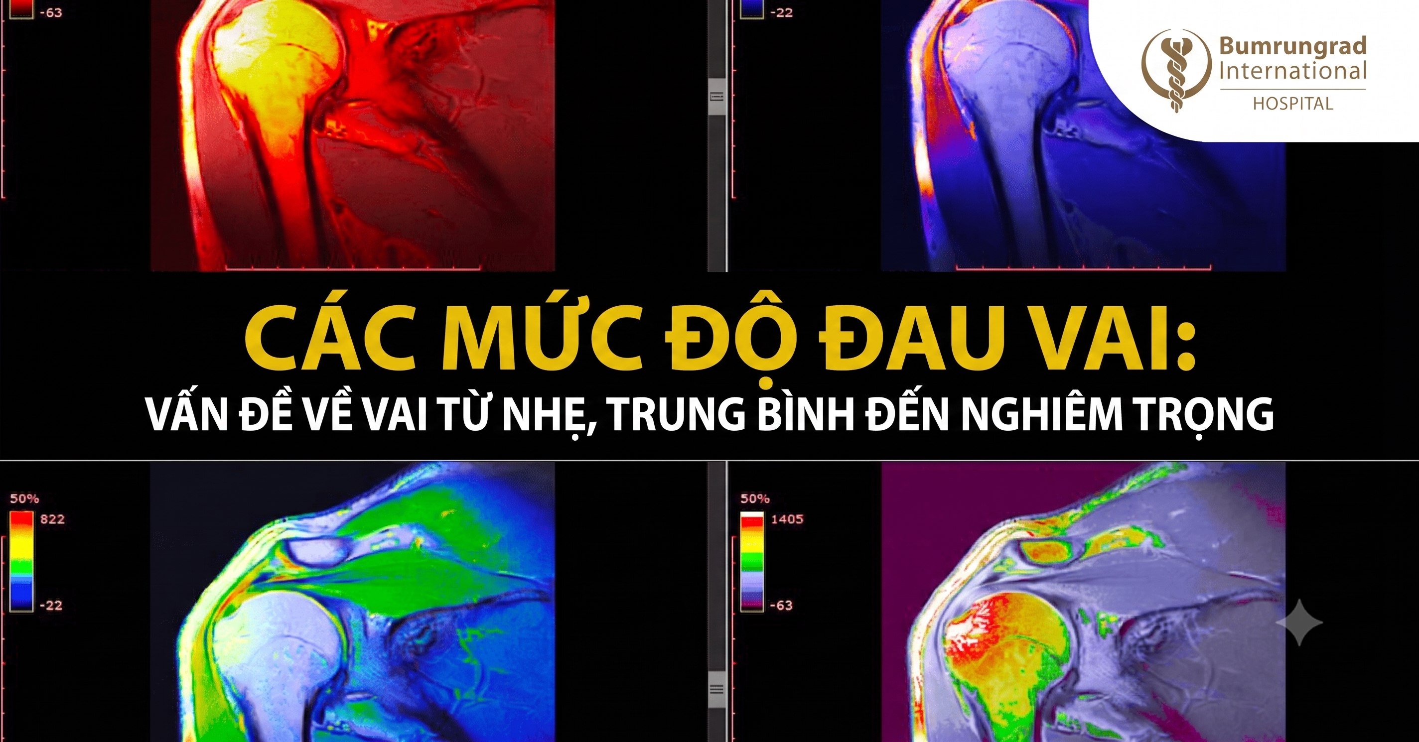 Các mức độ đau vai: Vấn đề về vai từ nhẹ, trung bình đến nghiêm trọng
